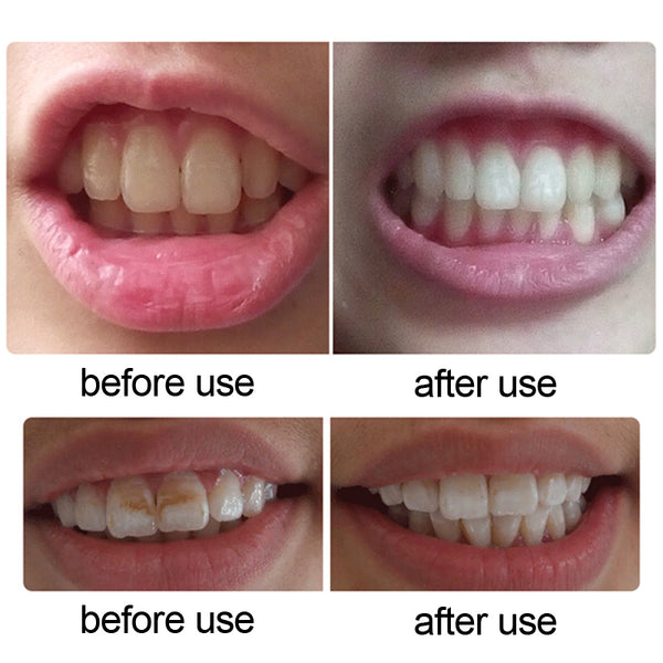 Dental Whitening Light Tool Kit