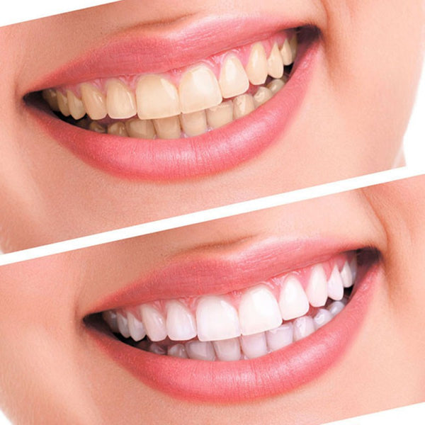 Peroxide Dental Bleaching System